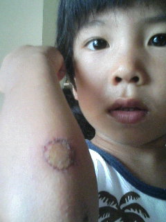 ぶどうのようなかさぶた